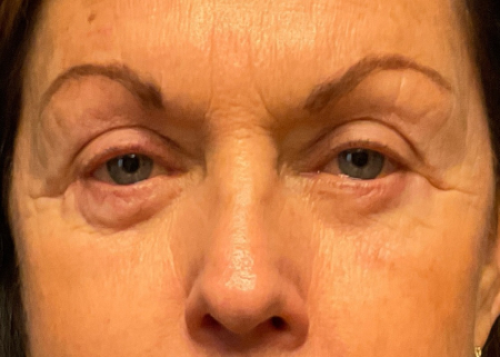 Blepharoplasty Patient 81690 Photo 2