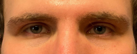 Blepharoplasty Patient 47242 Photo 2