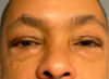 Blepharoplasty Patient 93638 Photo 1