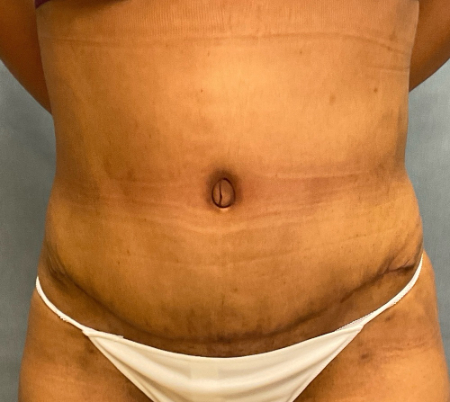 Abdominoplasty Patient 56032 Photo 2