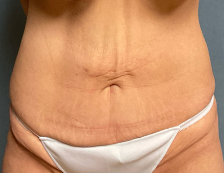 Abdominoplasty Patient 32529 Photo 1