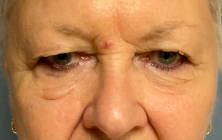 Blepharoplasty Patient 51907 Photo 1