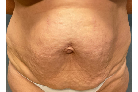 Abdominoplasty Patient 57721 Photo 1