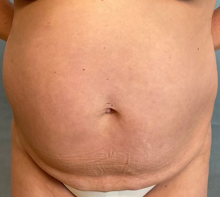 Abdominoplasty Patient 32592 Photo 2