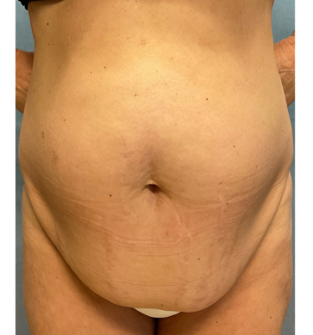 Abdominoplasty Patient 49051 Photo 1