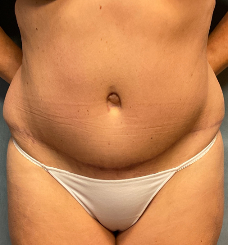 Abdominoplasty Patient 49051 Photo 2