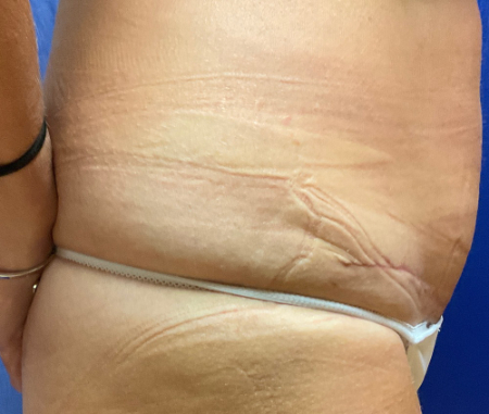 Abdominoplasty Patient 41491 Photo 2