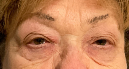 Blepharoplasty Patient 50382 Photo 1