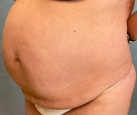 Abdominoplasty Patient 32328 Photo 2