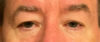 Blepharoplasty Patient 66863 Photo 1