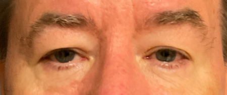 Blepharoplasty Patient 66863 Photo 1