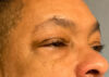 Blepharoplasty Patient 77914 Photo 1