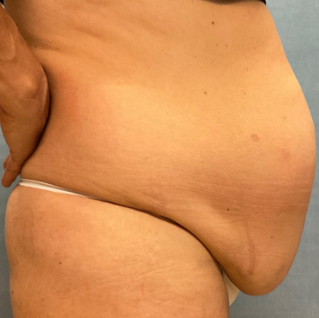 Abdominoplasty Patient 54842 Photo 1