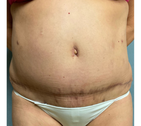 Abdominoplasty Patient 32592 Photo 1