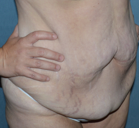 Abdominoplasty Patient 46633 Photo 1