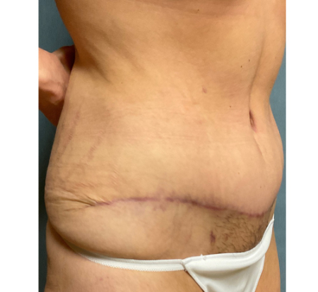 Abdominoplasty Patient 46633 Photo 2