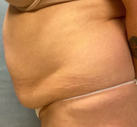 Abdominoplasty Patient 26634 Photo 1