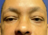 Blepharoplasty Patient 93638 Photo 2