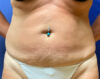 Abdominoplasty Patient 54080 Photo 1