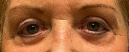 Blepharoplasty Patient 91727 Photo 1