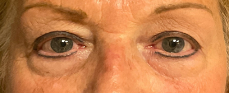 Blepharoplasty Patient 91727 Photo 2