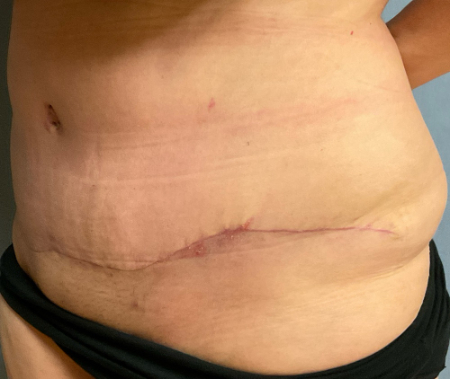Abdominoplasty Patient 47520 Photo 2