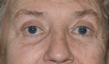 Blepharoplasty Patient 66050 Photo 2