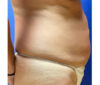 Abdominoplasty Patient 41491 Photo 1
