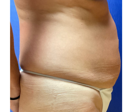 Abdominoplasty Patient 41491 Photo 1