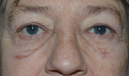 Blepharoplasty Patient 66050 Photo 1