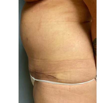 Abdominoplasty Patient 26634 Photo 2