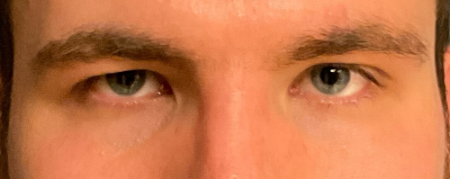 Blepharoplasty Patient 47242 Photo 1
