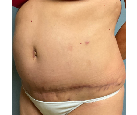 Abdominoplasty Patient 32328 Photo 1