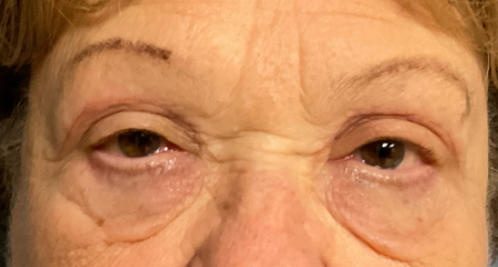 Blepharoplasty Patient 50382 Photo 2