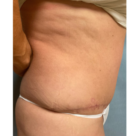 Abdominoplasty Patient 54842 Photo 2