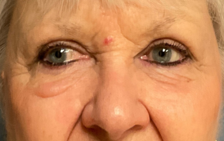 Blepharoplasty Patient 51907 Photo 2