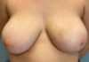Breast Reduction Patient 86073 Photo 1