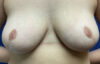 Breast Reduction Patient 86073 Photo 2