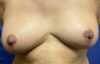 Breast Reduction Patient 11679 Photo 2