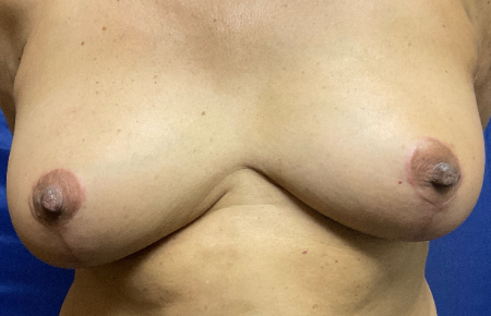 Breast Reduction Patient 11679 Photo 2