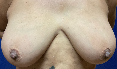 Breast Reduction Patient 11679 Photo 1