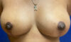 Breast Reduction Patient 38359 Photo 2